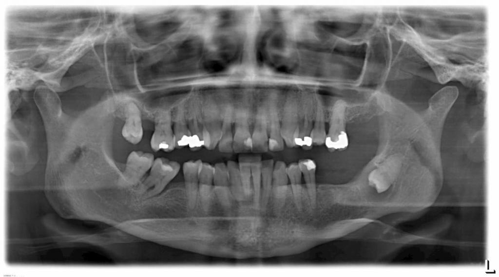 Siempre se quitan las muelas del juicio Dentista en A Coruña